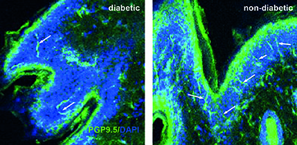 Intraepidermal nerve fiber in hind foot skin preparations in diabetic and control rats.