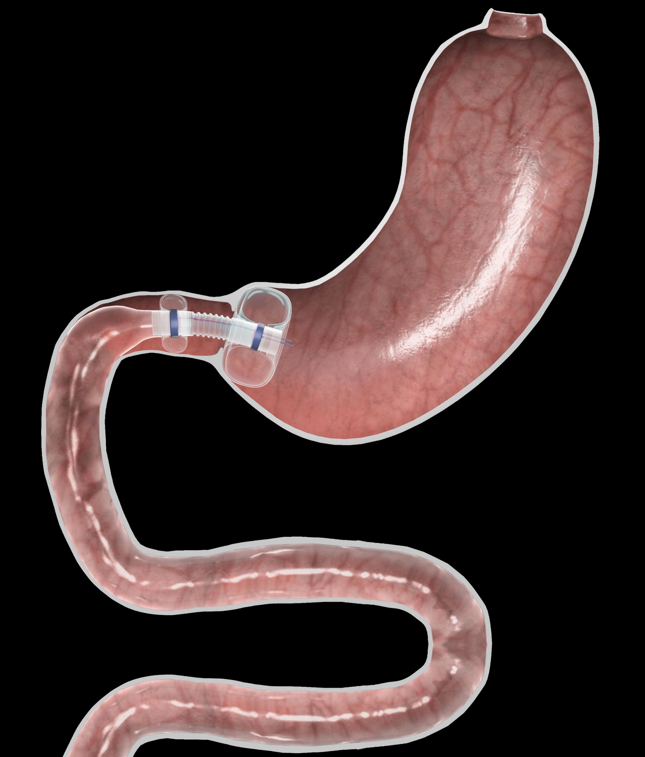 In dieser Grafik kann man erkennen, wie der Trans-Duodenal Barrier mit luftgefüllten Ballons am Übergang vom Magen zum Dünndarm fixiert wird. Diese Befestigungsmethode ist besonders schonend für den Körper.