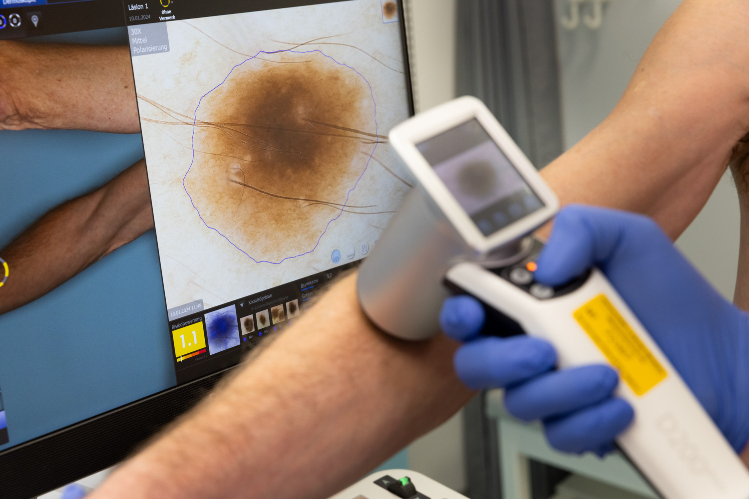 Mit der ergänzenden Videodermatoskopie ist ein hochauflösender Scan eines einzelnen Leberflecks möglich, um auszuschließen, dass es sich um den sogenannten schwarzen Hautkrebs handelt.
