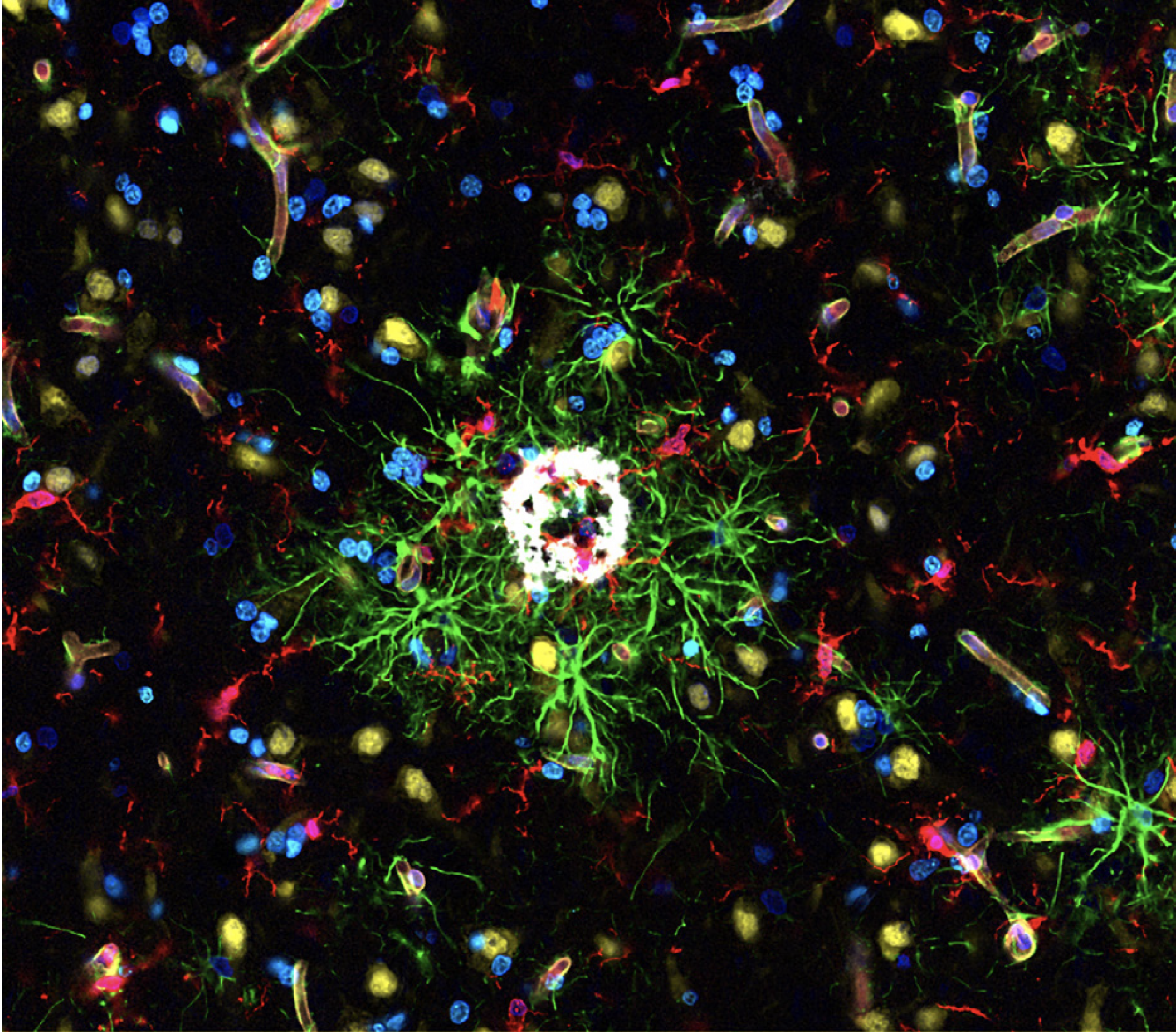Repräsentatives Fluoreszenzbild eines Gewebsschnitts aus dem Gehirn eines an der Alzheimer-Krankheit erkrankten Körperspenders. Die verschiedenen Zellpopulationen des menschlichen Gehirns sind in unterschiedlichen Farben dargestellt, wobei Mikrogliazellen (rot) in unmittelbarer Nähe zu den für die Alzheimer-Krankheit typischen Proteinablagerungen (weiß) zu finden sind.