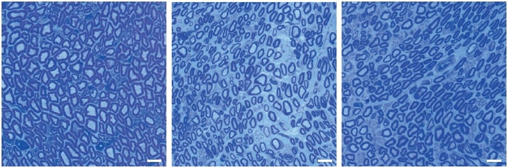 Im Vergleich zu gesunden Ratten (linkes Bild) sind in CMT Ratten (mittleres Bild) im Nervenquerschnitt weniger mit Myelin ummantelte Nervenfasern zu sehen, erkennbar als blaue Ringe. Eine Therapie von CMT Ratten mit Lecithin (rechtes Bild) erhöht die Anzahl myelinisierter Fasern.