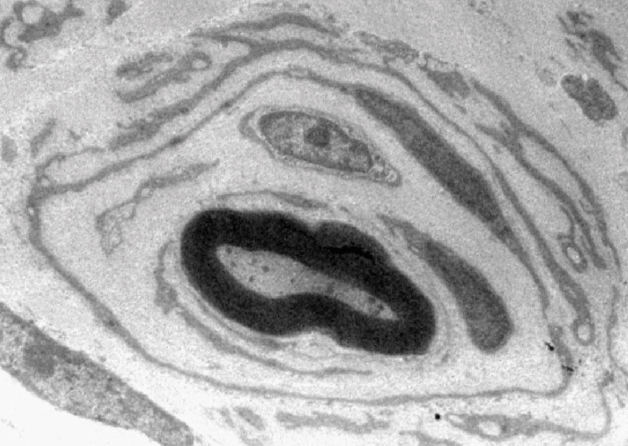 Elektronenmikroskopische Aufnahme eines an CMT1A erkrankten Nervs im Querschnitt (Vergrößerung 30.000 fach). An die innere mit Myelin (schwarzer Ring) ummantelte Nervenfaser lagern sich mehrere Schwann-Zellen ähnlich einer Zwiebelschale kreisförmig an