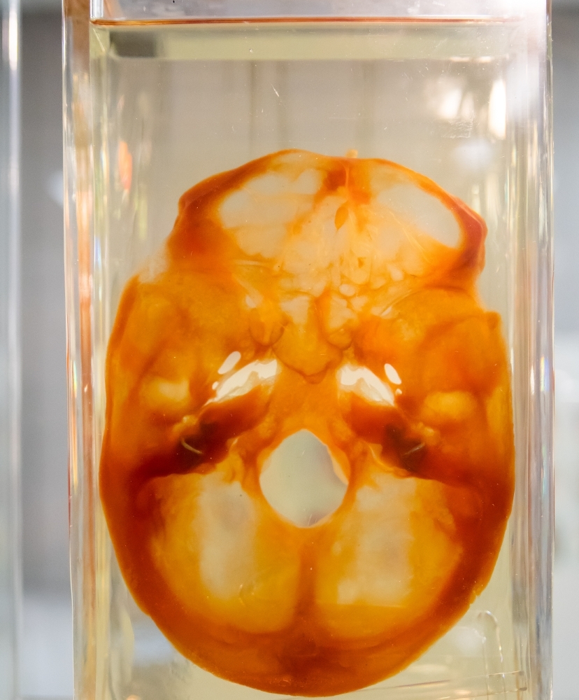 Die Schädelbasis ist noch ein Originalpräparat von Werner Spalteholz.