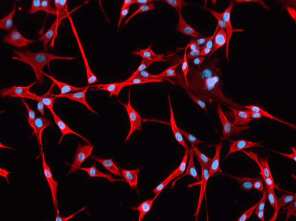 Zellkultur eines Glioblastoms: Blau sind die Zellkerne, rot die Zellkörper zu sehen. Sie wurden mit dem Protein Vimentin eingefärbt. Sehr starke Färbung bedeutet für Patienten nach einer aktuellen Studie eine sehr schlechte Prognose