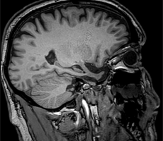 28.01.2026 <br> Minisymposium Demenzen 