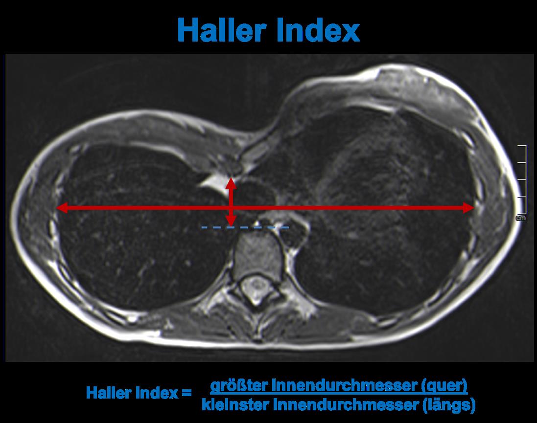 Trichterbrust_neu_3_Haller_MRT.jpg